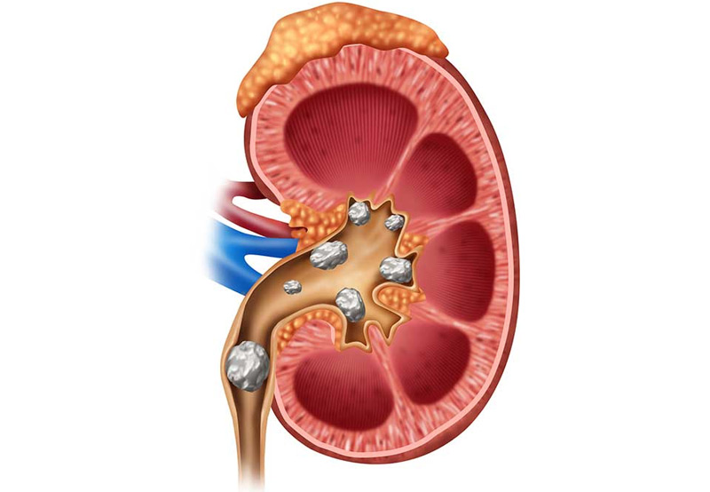 medical-concept-of-kidney-stones-UCI-Pediatric-Urology