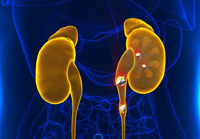 medical-concept-of-kidney-stones-on-one-side-UCI-Pediatric-Urology