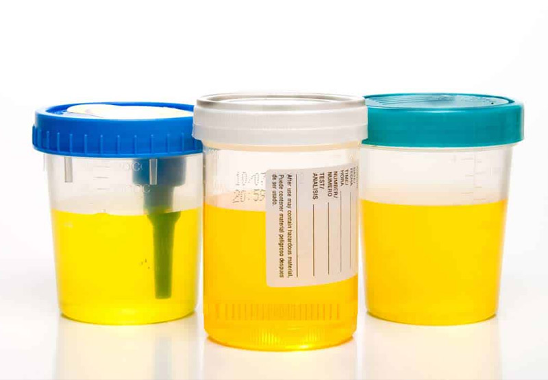 urinalysis-to-test-for-urinary-tract-infection-UCI-Pediatric-Urology