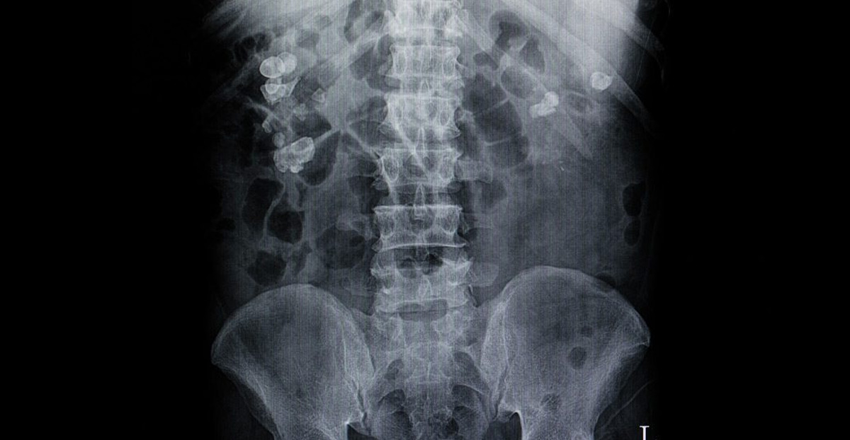 x-ray-of-kidney-stones-UCI-Pediatric-Urology