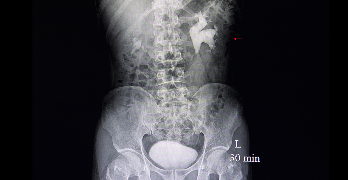 x-ray-showing-hydronephrosis-and-kidney-stones-UCI-Pediatric-Urology