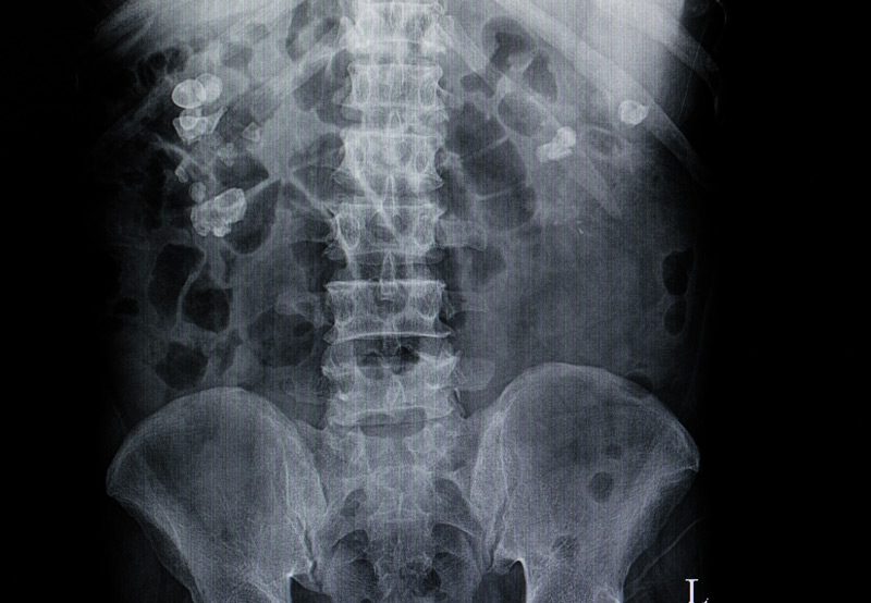 x-ray-showing-kidney-stones-a-symptom-of-ureteropelvic-junction-obstruction-UCI-Pediatric-Urology