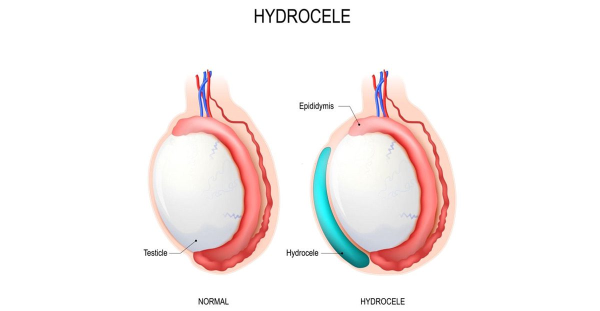 hydrocele-is-often-associated-with-an-inguinal-hernia-UCI-Pediatric-Urology