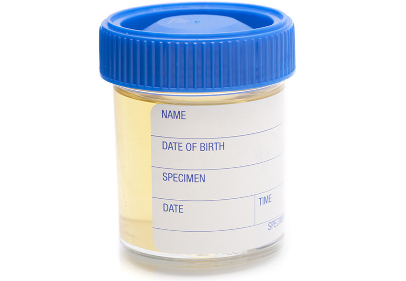urinalysis-to-test-for-urethral-strictures-UCI-Pediatric-Urology