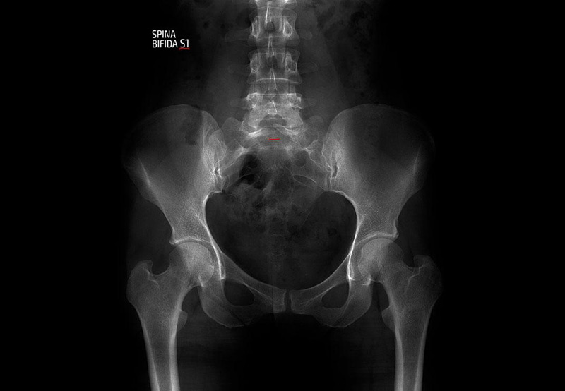 x-ray-showing-spina-bifida-UCI-Pediatric-Urology
